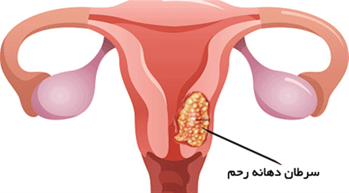 علائم سرطان واژن